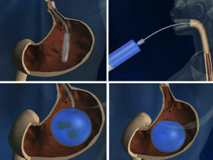 balon-intragastrico
